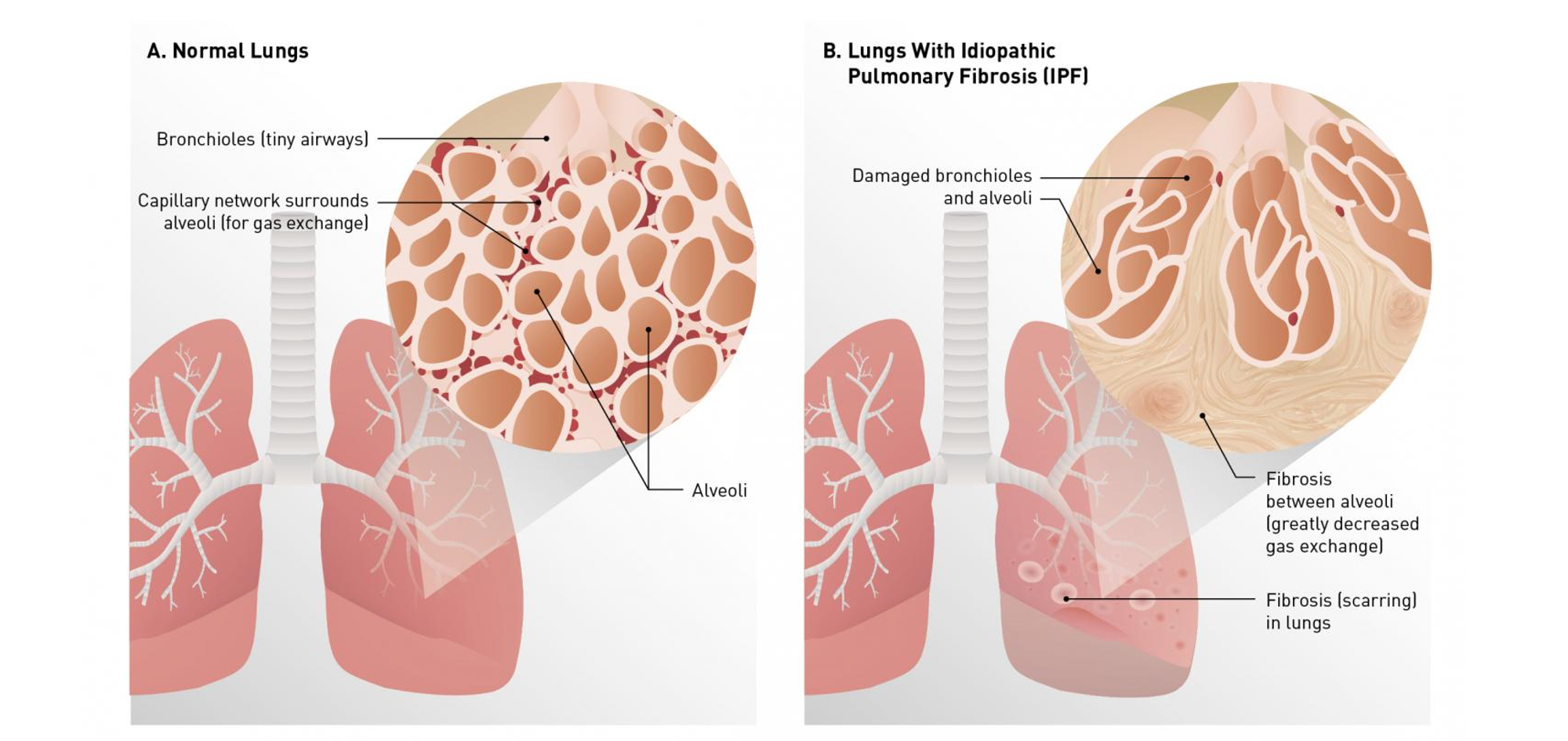 赢迪文献分享 | 特发性肺纤维化（IPF）的下一步疗法